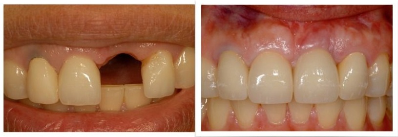 Trồng implant răng cửa 21 bị mất răng do tai nạn. Trung tâm implant Lạc Việt