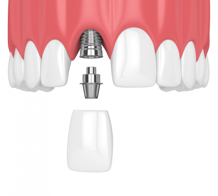 Cấy Ghép Implant Răng Cửa Có Nguy Hiểm Không? – Navii Blog