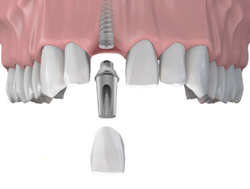 Trồng implant răng cửa - Giải pháp phục hình răng ưu việt