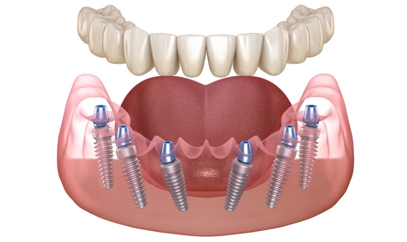 Kỹ thuật Implant All on 6